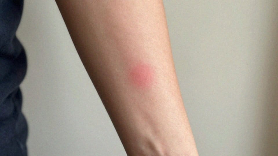 Jakie są objawy po ugryzieniu kleszcza?